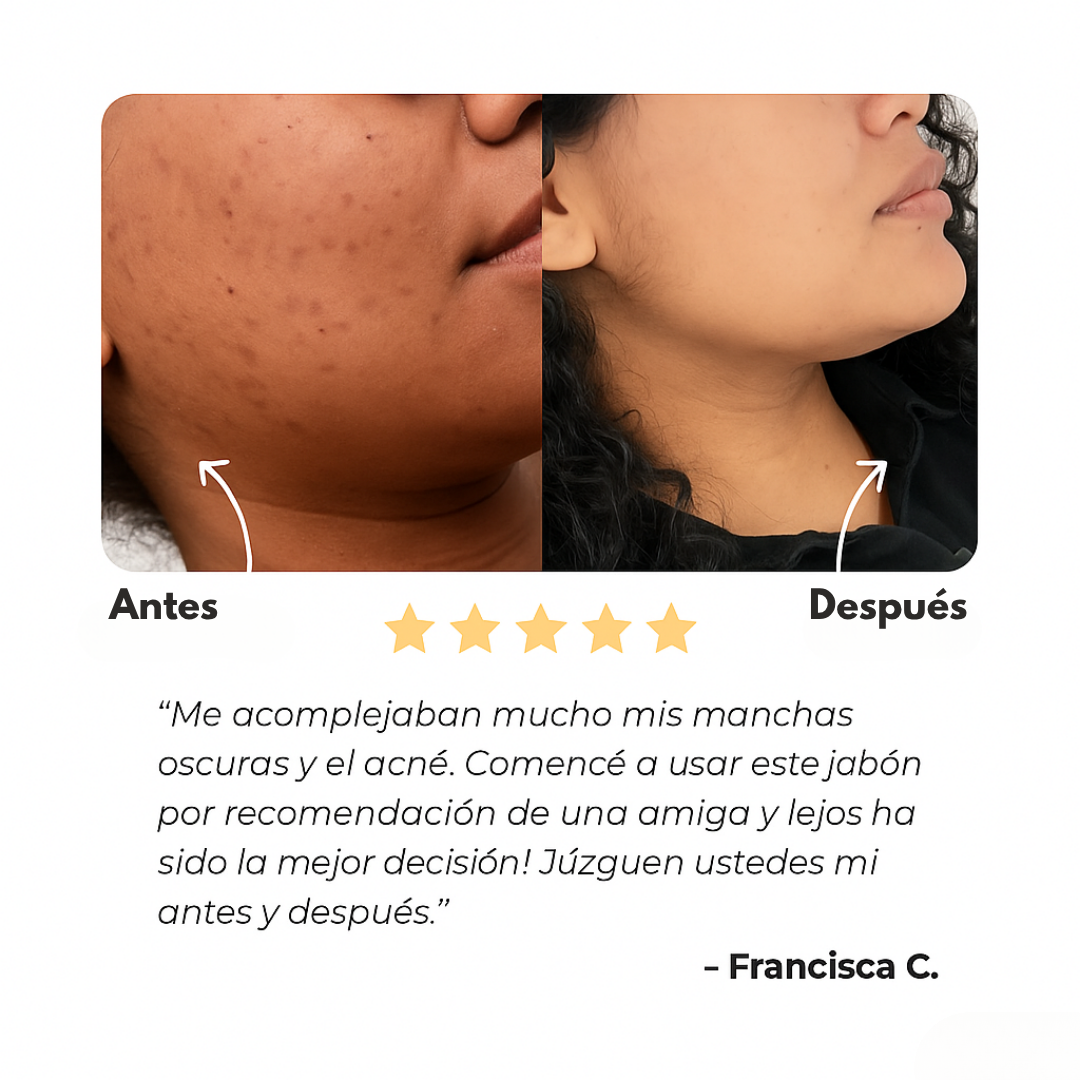 Kojic Radiance™ – Jabón natural anti manchas y acné