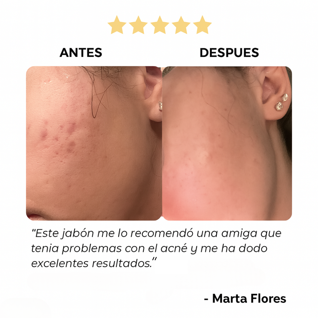 Kojic Radiance™ – Jabón natural anti manchas y acné