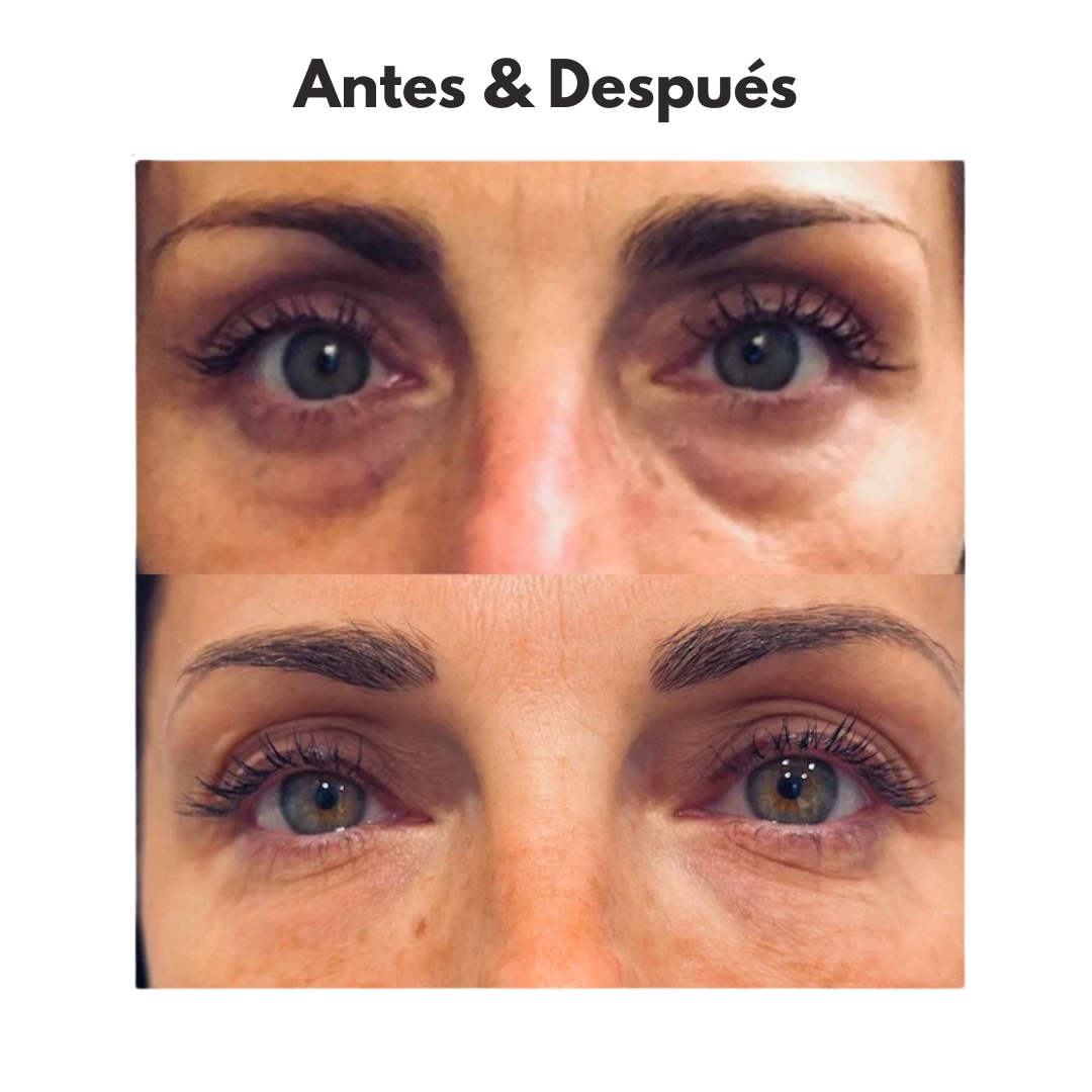 EyeBeauty™ - Terapia de luz roja para una mirada más joven